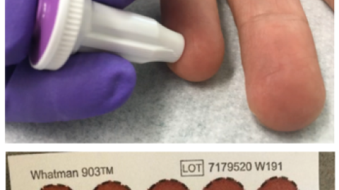 Needle pricking a finger for STBBI testing and dried blood spot test sample.
