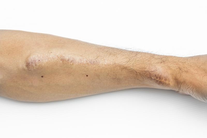 AV Fistula