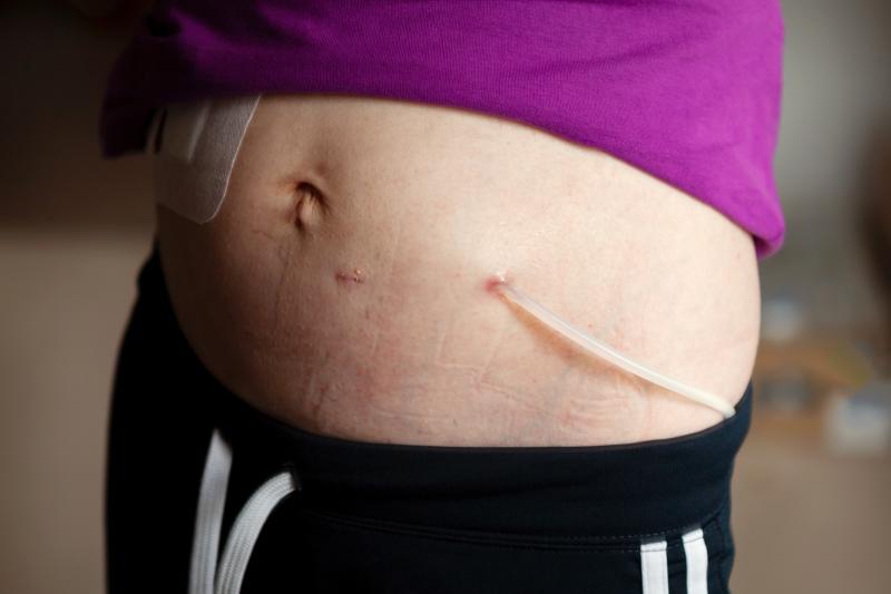 Exit Site Peritoneal Dialysis Catheter