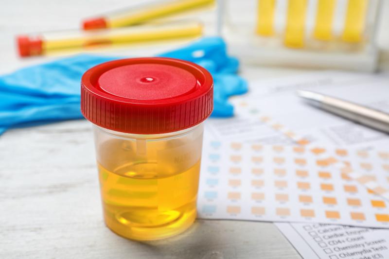 Urine Sample