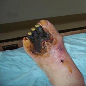 Arterial ulcer