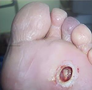 Diabetic ulcer