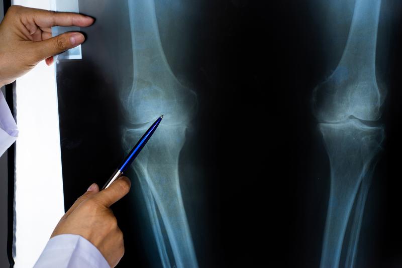 Knee X-Ray