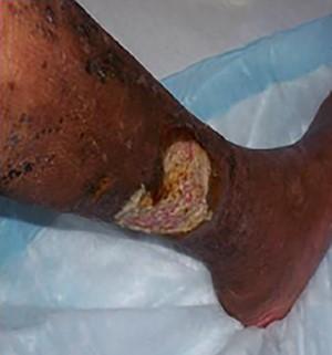 Venous ulcer